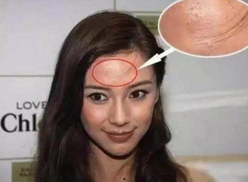 明星网红祛痘是谁